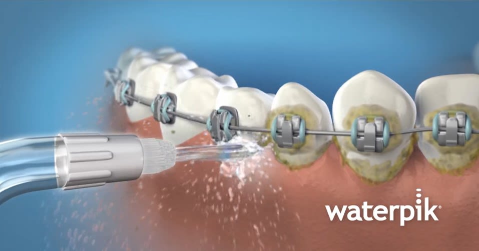 Visualisierung eines Gebiss mit Zahnspange, dass mit der WATERPIK WP-100EU Munddusche gereinigt wird