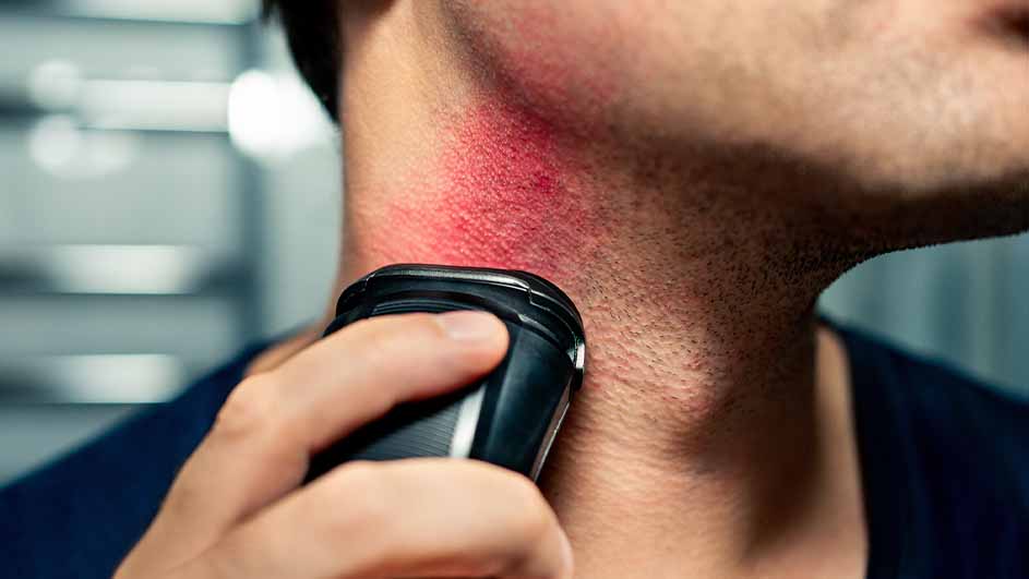 Een man scheert zijn hals met een zwart elektrisch scheerapparaat. De huid is rood. Achtergrond is een wazige grijze muur.