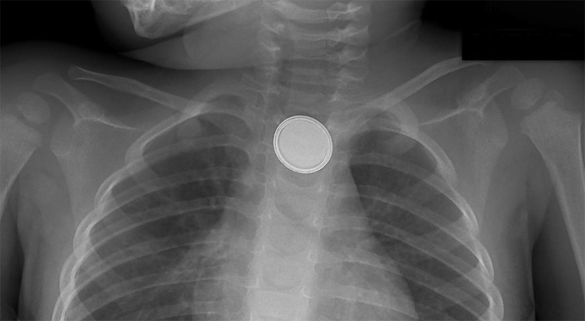 Ein Röntgenbild zeigt eine Münze, die in der Speiseröhre einer Person steckt, mit sichtbaren Rippen und Schlüsselbeinen.